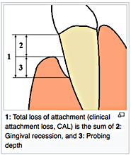 gingival recession