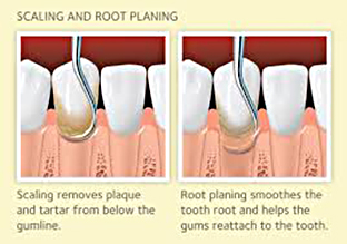 periodontal-treatment-scaling-root-planing